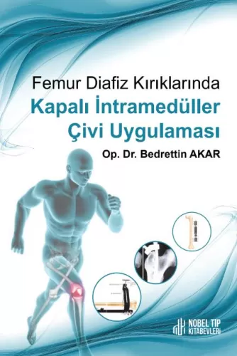 Femur Diafiz Kırıklarında Kapalı İntramedüller Çivi Uygulaması